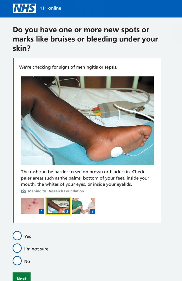 Screen grab of 111 online triage question showing an image of a meningitis rash on brown or black skin